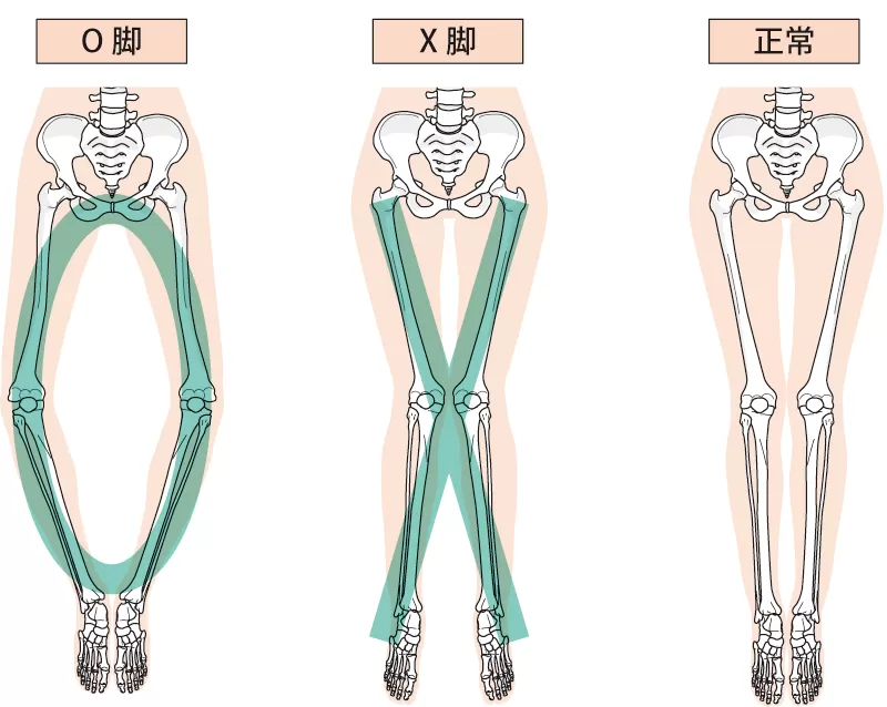 O脚を放置していると・・・