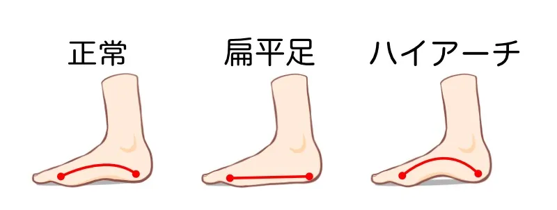 👣扁平足の原因と対処法【宮前区ファミリア整体院】
